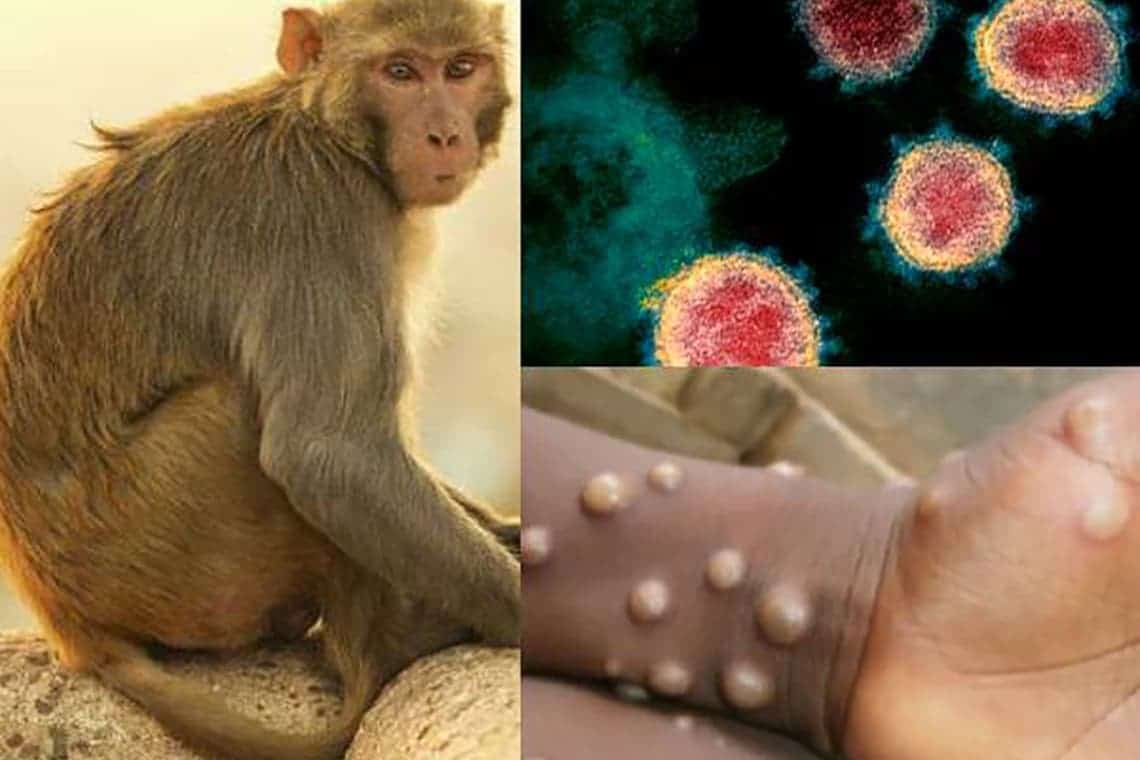 Asta mai lipsea: „variola maimuţei”, depistată la un pacient din Marea Britanie!