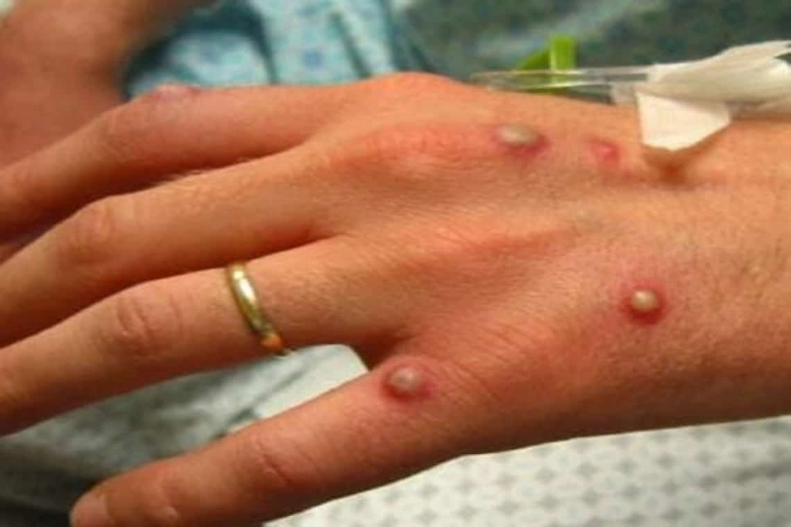 Al doilea caz de variola maimuței, diagnosticat în România