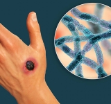 Două cazuri de antrax confirmate în România, la doi bărbați din Ialomița care au consumat carne de oaie