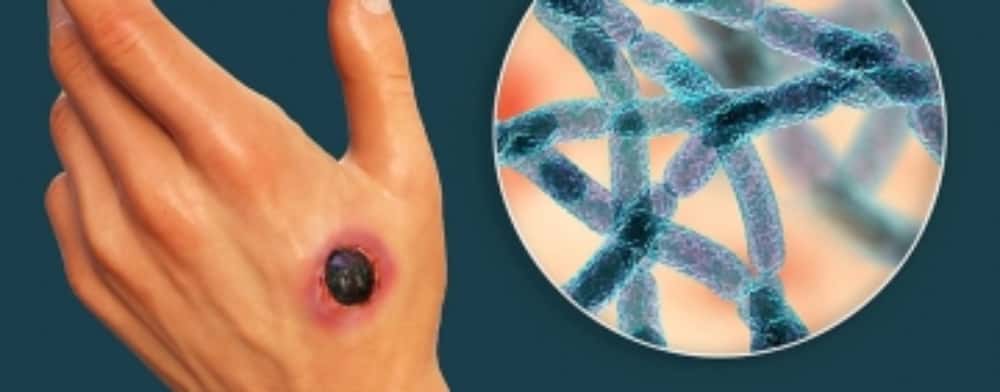 Două cazuri de antrax confirmate în România, la doi bărbați din Ialomița care au consumat carne de oaie