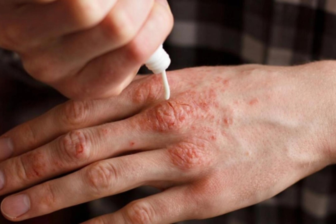 Caz de lepră confirmat în Cluj-Napoca, la o maseuză asiatică dintr-un salon SPA