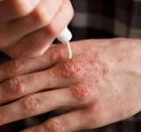 Caz de lepră confirmat în Cluj-Napoca, la o maseuză asiatică dintr-un salon SPA