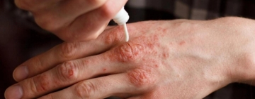 Caz de lepră confirmat în Cluj-Napoca, la o maseuză asiatică dintr-un salon SPA